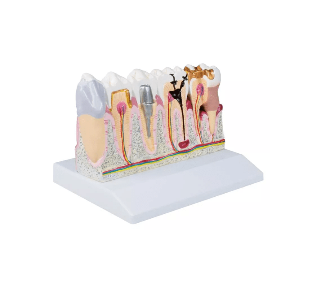 Dentalmodell, 4 - fache Größe - Erler - Zimmer